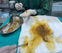 Nadir Görülen Vaka: Safra Kesesi'nden 2067 Taş Çıkarıldı